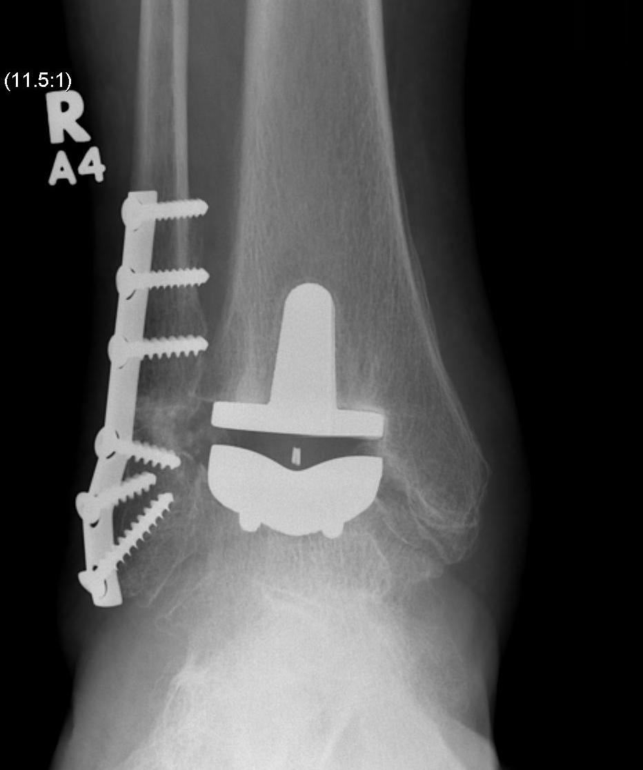 Ankle Arthroplasty AP